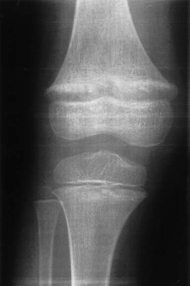 a%20girl%20e%20rickets%20and%20nephrocalcinosis